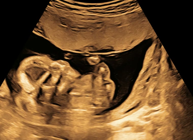 Echobeeld: het profiel van de baby, hoofdje links, vuistjes voor de borst